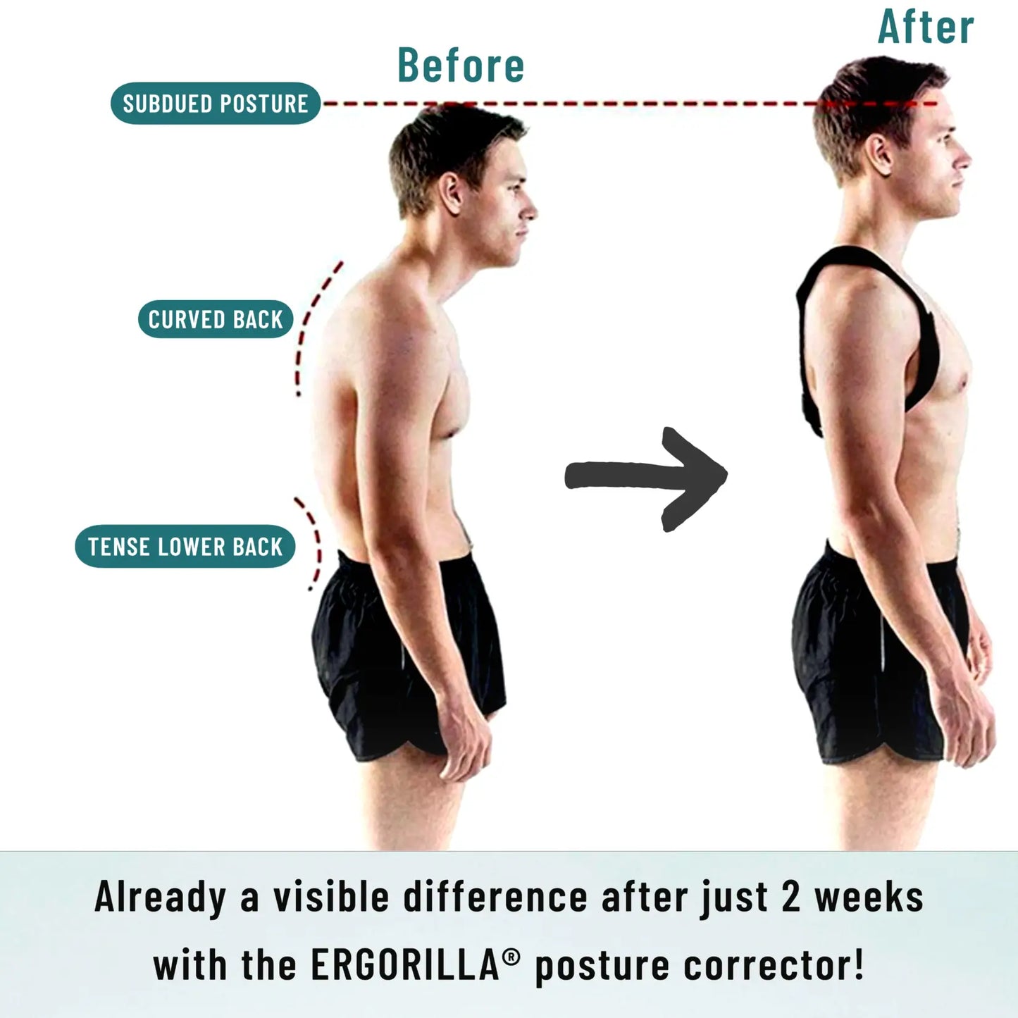 Posture Corrector